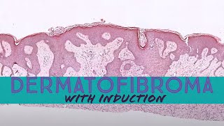 Dermatofibroma with induction phenomenon pathology dermpath dermatology dermatopathology [upl. by Hay507]