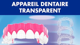 INVISALIGN  Traitement dappareil dentaire TRANSPARENT © [upl. by Laresa]