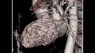 Cardiac perfectly timed cardiac CT angiographic study with normal anatomy 1 of 16 [upl. by Pelson]