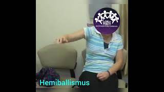 HEMIBALLISMUS [upl. by Oicnevuj]