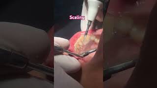 Scaling umairtoothfairy dentist umairazeem smile calculus Umairazeem8553 [upl. by Hoes]