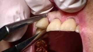 Physics Forceps Informational Video 2013  Golden Dental Solutions [upl. by Quenby244]