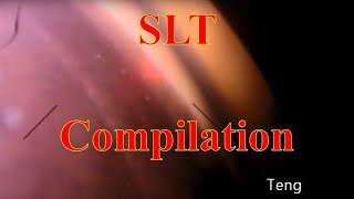 Selective Laser Trabeculoplasty SLT Compilation Chris Teng MD [upl. by Aztiraj976]