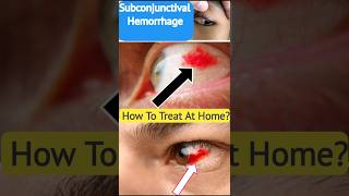 Subconjunctival Hemorrhage shorts viralvideo shortvideo [upl. by Nylzaj]