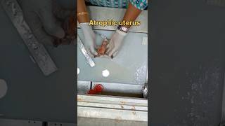 Atrophic uterus specimen அட்ராபிக் கருப்பை  biopsy satisfying pathology histopathology [upl. by Elsy]