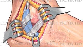 Ankle Arthroscopy and Open Repair [upl. by Jerroll]