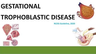 Gestational Trophoblastic Disease  RCOG guideline 2020 [upl. by Poirer903]