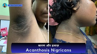 Acanthosis nigricans Treatment  dark neck treatment  काले गर्दन का इलाज  Dr Uttam Kumar Lenka [upl. by Goodden]