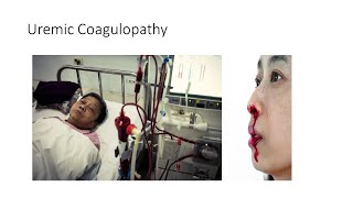 Uremic Coagulopathy [upl. by Sirak]