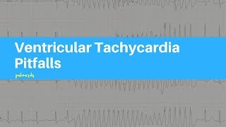 Ventricular Tachycardia Pitfalls [upl. by Frydman]