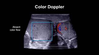 Diagnosing testicular torsion [upl. by Icats413]