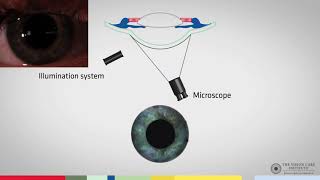 Slit Lamp Techniques Conical Beam [upl. by Auqinimod]