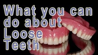 What can be done about loose teeth [upl. by Nanci]