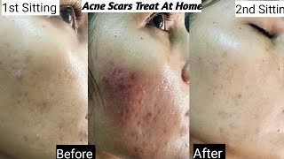 2nd Sitting For Acne Scars  Before After Results  Acne Scars chiken pox scars [upl. by Joed]