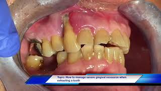 How to manage severe gingival recession during extraction [upl. by Adelaide]