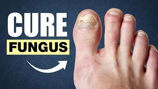 10 Effective Home Remedies To Cure Toenail Fungus [upl. by Newol29]