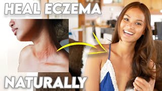 How to TREAT ECZEMA and what causes it [upl. by Miko]