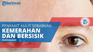 Dermatitis Seboroik Penyakit yang Menyebabkan Kulit Berwarna Merah Berketombe dan Bersisik [upl. by Yeruoc]