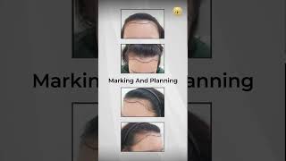 HAIR TRANSPLANT MALAYSIA  Hairline Transplant Witness the Transformation [upl. by Vowel835]