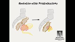 Doctor Explains Radiation for Rising PSA after Prostate Cancer Surgery [upl. by Anib]