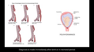 Types of esophageal atresia and tracheoesophageal fistula [upl. by Mata162]