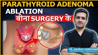 Parathyroid Adenoma Causes Symtoms and Treatment Dr Gaurav Gangwani Interventional Radiologist [upl. by Fatma]