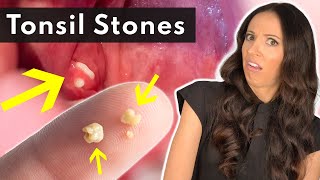 What Are Tonsil Stones amp How To SAFELY Remove Them [upl. by Noreh]