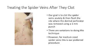 Treating Spider Vein Complexes Using a Combination of Tumescent amp Foam Sclerotherapy [upl. by Eeroc]