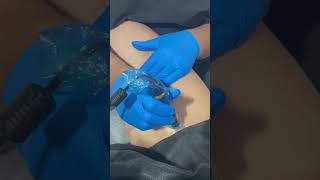 Esthetician performs cellulite treatment on the leg and thigh shorts [upl. by Wiener513]