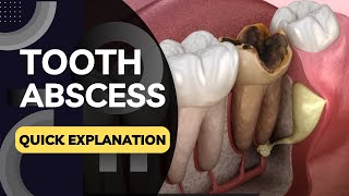 What is a Tooth Abscess Quickly Explained in a Few Seconds [upl. by Yaffit]