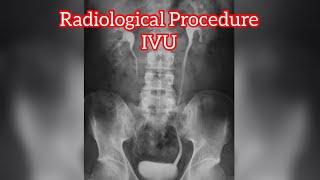 IVU  IVP Procedure  Radiology Procedure  Radiographer  Rso [upl. by Ajdan]