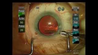 Safe And Easy Modern Cataract Surgery 5 minute procedure  Louisville KY Albert Smolyar [upl. by Welcome503]