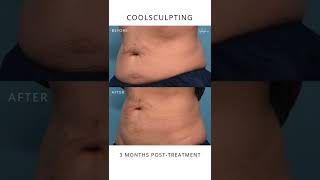 CoolSculpting Results Before and after 3 months [upl. by Marigolde]