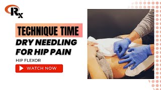 Dry Needling for Hip Pain [upl. by Cogswell]