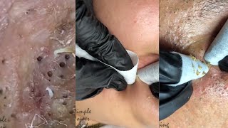 Ultimate Blackhead Removal TikTok Compilation  Satisfying Pimple Popping Videos Best of WEEK [upl. by Haonam]