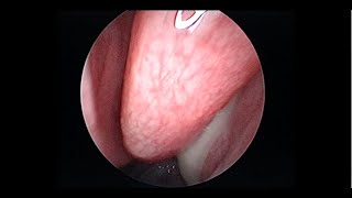 Acute Sinusitis with Postnasal Drip [upl. by Reba423]