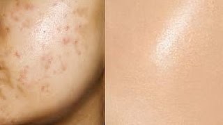 Remove Acne Marks  3 Step  Natural Remedies for Pimple Marks   Prachi SuperWowStyle [upl. by Llerryt175]