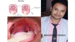 Quinsy Acute tonsillar infection के बारे में समझें।wait for end quinsy tonsillitis [upl. by Allwein]