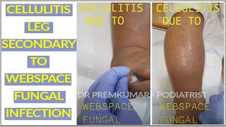 Cellulitisleg fungalinfectionfoot DrPremsDiabeticFoot  footcarepurasawalkam Diabetes [upl. by Johppah]