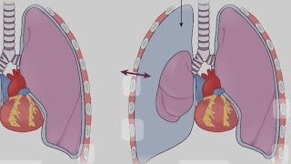 Emergencias Neumológicas Neumotórax [upl. by Erica265]