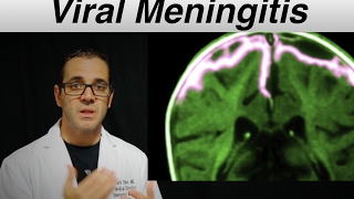 viral meningitis  Patient Education Video [upl. by Adnylem47]