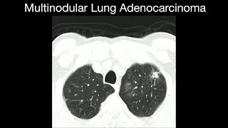 Multinodular Lung Adenocarcinoma [upl. by Gilbertson]