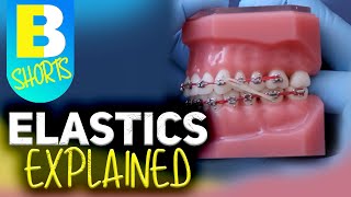 Braces Elastics Explained shorts [upl. by Ardnauqal]