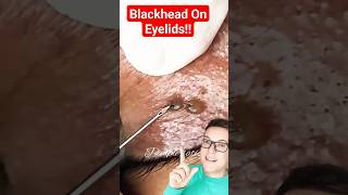 No Way  CRAZY BLACKHEAD REMOVAL On Eyelid shorts [upl. by Baptiste]