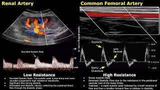 Difference Between Low Resistance amp High Resistance Waveforms On Spectral Doppler Ultrasound USG [upl. by Goodyear]