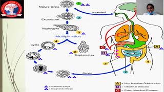 Amoebic Liver Abscess  Dr Janani [upl. by Territus]