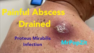 Painful large abscess infected with Proteus Mirabilis drainedCyst contents start at 1410 Amazing [upl. by Mignonne475]