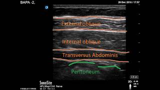 Transversus Abdominis Plane scanning [upl. by Maitland]