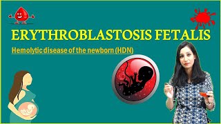 Erythroblastosis Fetalis  Hemolytic Disease of Newborn  Hematology [upl. by Atal]