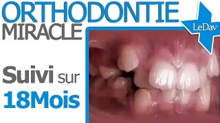 APPAREIL DENTAIRE Suivi Photo 18 MOIS  Traitement Orthodontie [upl. by Duane13]